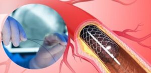 Coronary Angioplasty
