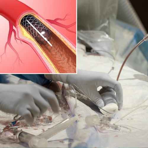 angioplasty